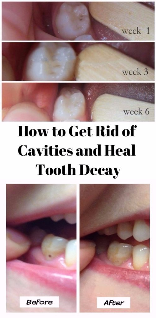 How to Get Rid of Cavities and Heal Tooth Decay